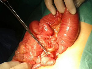 Invaginación ileal a pocos centímetros de la válvula ileocecal (apéndice normal).
