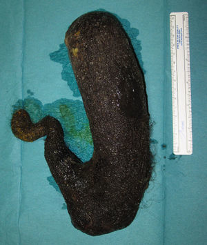 Tricobezoar extraído.