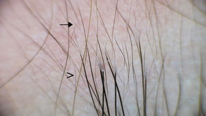Tricoscopia. Área afecta con pelos vellosos (→), rodeada de piel sana con pelo terminal normal (>).