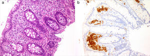 Mucosa colorrectal que muestra un infiltrado de células de hábito histiocitario en la lámina propia (a). Tinción positiva para CD1a en la celularidad descrita (b).