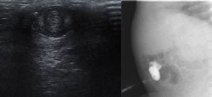 Ecografía y fistulografía: inserción de un catéter a través del orificio de la lesión; se visualiza relleno del trayecto y del asa intestinal.
