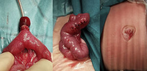 Hallazgos operatorios: exéresis del conducto onfalomesentérico con sutura del defecto y resultado umbilical final.