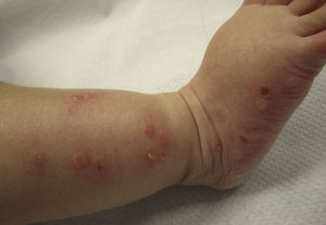Segundo brote de lesiones en distintas fases: vesículo-pústulas con eritema perilesional y costras en pie derecho.