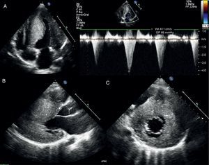 Ecocardiograma transtorácico, muestra hipertrofia biventricular severa. A) Plano paraesternal 4 cámaras. Puede observarse la alteración de la relajación con colapso medioventricular protosistólico con gradiente pico de hasta 68mmHg. B) Plano paraesternal longitudinal del ventrículo izquierdo. En sístole, podemos ver el contacto de la valva septal de la válvula mitral con el septo (SAM). C) Plano paraesternal transversal del ventrículo izquierdo. Permite localizar la extensión de la hipertrofia que afecta tanto al septo anterior como al posterior.