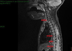 Imagen de resonancia magnética nuclear con lesiones osteolíticas en varios cuerpos vertebrales, alguno de ellos mostrando aplastamiento vertebral.