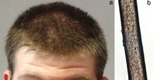 a) Cabello plateado y b) Gránulos de pigmento distribuidos regularmente en el pelo (microscopia óptica).