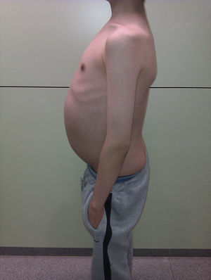 Imagen del paciente con la destacada distensión abdominal.