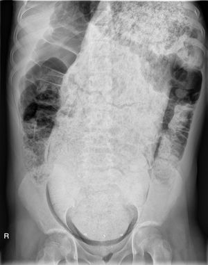 Radiografía abdominal que muestra megarrecto con abundante materia fecal de pelvis a epigastrio.