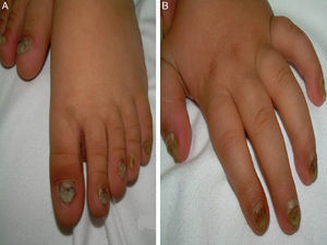 A) Hiperqueratosis subungueal distal y cromoniquia en pies. B) Hiperqueratosis subungueal distal y cromoniquia en manos.