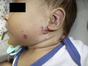 Paciente de 3 meses de edad con hemangioma facial a lo largo del dermatomo correspondiente a la tercera rama del nervio trigémino del lado izquierdo.