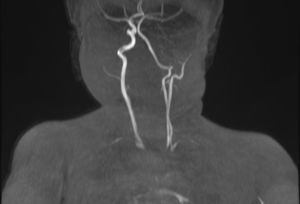 Imagen de la angioresonancia cervical en la que se observa la hipoplasia/aplasia de arteria carótida interna izquierda, con una compensación de la vertebral izquierda.
