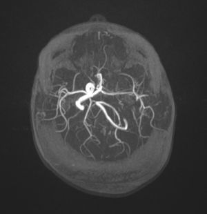 Imagen de la angioresonancia en la que se observa el polígono de Willis competente con arteria comunicante anterior seudoaneurismática que da origen a arterias cerebrales anteriores y arteria cerebral media izquierda levemente hipoplásicas.