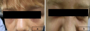 Paciente de 7 años, con numerosas verrugas víricas en región facial (a), resueltas de forma completa tras tratamiento durante un mes (b).