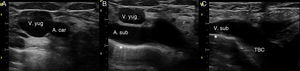 Exploración ecográfica del TBC derecho. A) Plano transversal de la yugular interna y carótida derechas. B) Deslizando el transductor siguiendo la yugular interna se identifica la arteria subclavia. C) Angulando el transductor hacia anterior se obtiene el eje longitudinal de la vena subclavia y su continuación al TBC. * Indica la pleura.