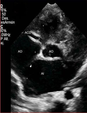 Ecocardiografía transtorácica. Proyección eje corto evidenciando la dilatación de arteria coronaria derecha (ACD).