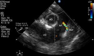 Ecocardiografía transesofágica. Se observa la salida de la arteria coronaria izquierda (ACI, flecha) originándose en el tronco de arteria pulmonar (AP).