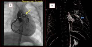 A) Aortografía en proyección PA en la que se observa únicamente el origen de la arteria coronaria derecha de su seno de Valsalva correspondiente, llegando el contrate a la arteria coronaria izquierda y tronco pulmonar a través de múltiples colaterales. B) Reconstrucción 3D de la anatomía coronaria para la evaluación espacial de la cardiopatía. Flecha: salida de ACI de AP.