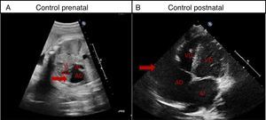 Caso 1. Dilatación de orejuela derecha. A) Ecocardiografía fetal a las 31 semanas de edad gestacional en la que se señala la dilatación de orejuela derecha. B) Ecocardiografía: último control postnatal a los 18 meses de edad con dilatación de orejuela derecha de 5cm2 (flecha).AD: aurícula derecha; AI: aurícula izquierda; VD: ventrículo derecho; VI: ventrículo izquierdo.