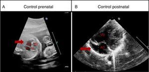 Caso 2. Dilatación de orejuela derecha. A) Ecocardiografía fetal a las 22 semanas de gestación, se señala la dilatación de orejuela derecha. B) Control ecocardiográfico postnatal al año de vida con dilatación de orejuela derecha de 6mm de diámetro (flecha).AD: aurícula derecha; AI: aurícula izquierda; VD: ventrículo derecho; VI: ventrículo izquierdo.