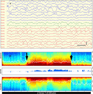 Caso 1: A) EEG en el que se observan frecuentes descargas epileptiformes focales involucrando la totalidad del lóbulo frontal derecho (Fp2, F4, F8) y exceso de ondas lentas en la región temporo-occipital izquierda; filtro bajo: 0,53Hz; filtro alto: 30Hz; filtro de red: 50Hz. Barra vertical: 100μV, barra horizontal: 1s; B) MDE que muestra un cambio brusco en el color (flecha larga) pasando de tonos naranjas, amarillos y verdes en la banda de baja frecuencia (<10Hz) a tonos rojos oscuros, indicativo de la recurrencia de la actividad epiléptica. Tras algo más de una hora, la MDE vuelve a su situación previa coincidiendo con la administración de tiopental (flecha corta). La línea blanca dentro de la MDE indica la frecuencia de borde espectral (SEF) que es el valor de frecuencia en hercios por debajo del cual se sitúa el 95% de las ondas cerebrales. (En versión impresa a blanco y negro, el color rojo oscuro en la banda de baja frecuencia equivale a tonos grises oscuros cercanos al negro).
