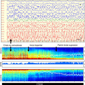 Caso 2: A) EEG con evidencia de descargas epileptiformes de complejos punta onda entre 2-3Hz y hasta 300μV de amplitud, bilaterales, con máximo en el lóbulo temporal y área parieto-occipital del hemisferio derecho (F8, T4, T6, O2). Filtro bajo: 0,53Hz; filtro alto: 30Hz; filtro de red: 50Hz. Barra vertical: 200μV, barra horizontal: 1s; B) MDE caracterizada inicialmente por un patrón en forma de espigas de color rojo oscuro de predominio derecho debido a la gran amplitud de las descargas epilépticas en ese lado. Tras el inicio de perfusión de tiopental se observa un cambio progresivo en la MDE hasta alcanzar tonos azules predominantes indicando una caída en la amplitud de las ondas cerebrales compatible con un patrón de brote-supresión. (En versión impresa a blanco y negro, el color rojo oscuro en la banda de baja frecuencia equivale a tonos grises oscuros cercanos al negro. Tras el inicio del tiopental esos tonos disminuyen progresivamente bajo la linea blanca (SEF) hasta desaparecer).