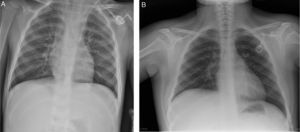 A) Radiografía de tórax evidencia desplazamiento de la punta del catéter a izquierda hasta el seno coronario. B) Ejemplo de comprobación de Port-a-Cath en paciente sin alteración anatómica.