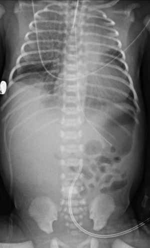 Radiografía de tórax donde se observan áreas de hiperinsuflación pulmonar y corazón en zueco.