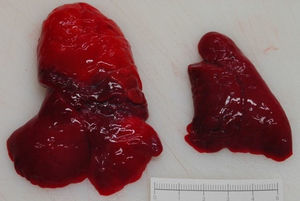 Pulmón derecho de 36g, lóbulo inferior atelectásico, superior y medio agrandado, hallazgos sugestivos de enfisema lobar congénito. Pulmón izquierdo de 12g, aspecto atelectásico/hipoplásico.