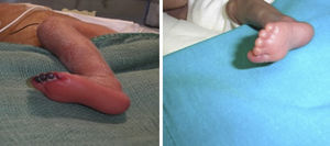 Evolución de lesiones isquémicas en dedos del pie de un prematuro, tras uso de nitroglicerina tópica al 2%.