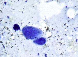 Frotis de Tzank. Se ha teñido el fondo de una de las vesículas con azul de toluidina. Se puede observar una célula gigante multinucleada con núcleos claros amoldados, compatible con infección por el virus varicela-zóster.