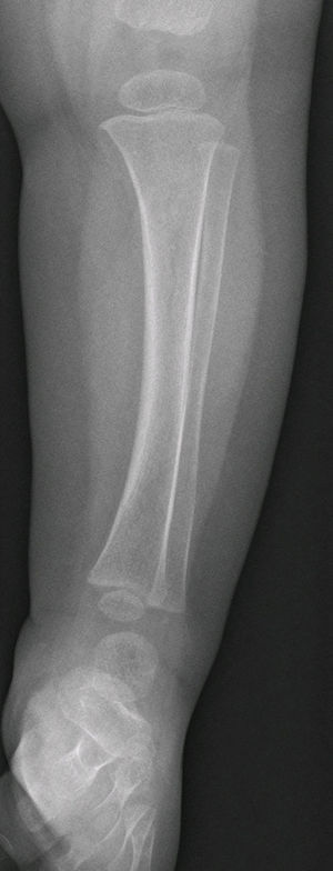 Radiografía simple de tibia peroné. Proyección anteroposterior. No se observan líneas de fractura.