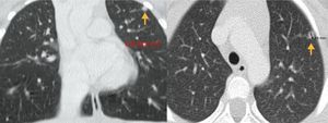 Imágenes de las TC torácica (axial y coronal), que muestran un nódulo de 4×2mm en el lóbulo superior izquierdo.