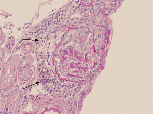 Biopsia renal: necrosis fibrinoide y 35% de semilunas epiteliales; depósitos mesangiales de IgM y C3 con IgG negativos a la inmunofluorescencia. Glomérulo con semiluna epitelial (→). PAS ×40.