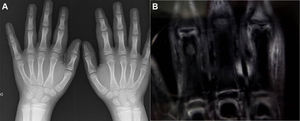 A) Imagen radiográfica de las manos del paciente, donde no se observa afectación ósea. B) Imagen de la RM de las manos, donde se observa aumento de tejidos blandos sin afectación articular.