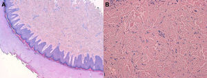 Imagen histológica (tinción hematoxilina-eosina). A) Se observa epidermis hiperplásica con patrón psoriasiforme, hiper y ortoqueratosis (aumento ×4). B) Se observa dermis con aumento de las fibras de colágeno y de fibroblastos (aumento ×20).
