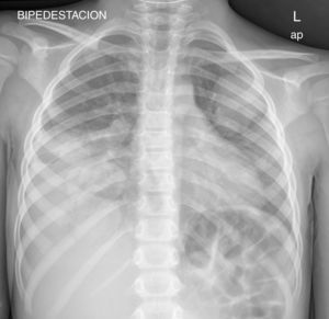 Radiografía de tórax. Múltiples nódulos pulmonares bilaterales y derrame pleural derecho.