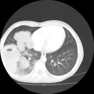Tomografía axial computarizada pulmonar, ventana pulmonar. Masas pulmonares de densidad agua en hemitórax derecho, una de ellas cavitada.