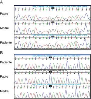Electroferogramas con la variante c.502G>A (p.Ala168Thr, rs374601719) en exón 4 (A) y la variante c.877C>T (p.Gln293*) en exón 7 (B).