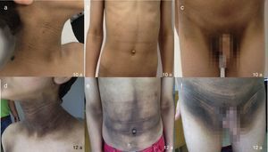 Evolución de la acantosis nigricans en diferentes áreas del cuerpo, algunas poco habituales (b y e: abdomen, flexura de codos), a los 10 (a-c) y a los 12 años de edad (d-f) en un niño con el síndrome de Rabson-Mendenhall.