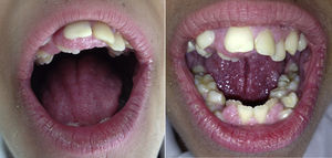 Apiñamiento dental e hipertrofia gingival en el síndrome de Rabson-Mendenhall.