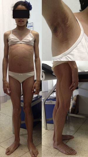 Niña de 12 años que padece una lipodistrofia generalizada adquirida (síndrome de Lawrence), y en la que se aprecia la ausencia generalizada de tejido adiposo, la musculatura bien definida y la acantosis nigricans.