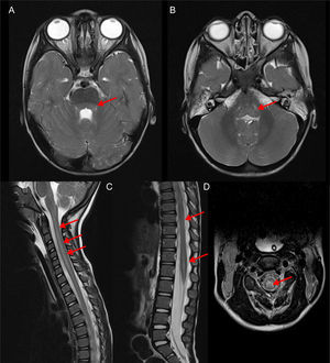 Rombencefalomielitis por EV-D68: imágenes de RM craneoespinal potenciadas en T2, obtenidas en la fase aguda de la enfermedad. Las flechas indican la afectación dorsal a nivel tegmental protuberancial (A) y bulbar (B) así como holomedular (C) con predominio en la sustancia gris (D) (Cortesía Dr. Ignacio Delgado, Servicio de Radiología).