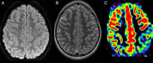 A) Imagen axial ponderada en difusión. B) Imagen axial ponderada en T2. C) Mapa cualitativo de flujo cerebral, con secuencia de perfusión sin contraste, pseudocontinuous arterial spin-labeling (ASL).