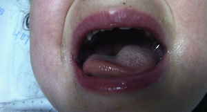 Fotografía de la cavidad oral que muestra engrosamiento de la hemilengua izquierda.