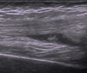 Ecografía de la rodilla derecha. Se observa una colección hipoecoica con ecos en su interior, en el receso suprapatelar derecho, así como una hipertrofia sinovial moderada.