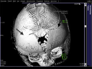 TAC craneal (reconstrucción 3D). Fusión sutura coronal bilateral (flechas). Fontanela anterior muy amplia con desplazamiento anterior.