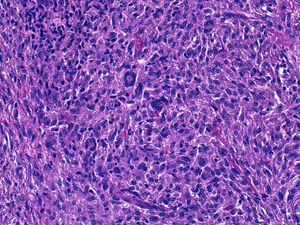 Histiocitos con citoplasma espumoso junto con células gigantes multinucleadas (H&E ×100).