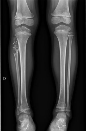 Imagen típica de lesión encondral en «palomitas de maíz» en peroné proximal derecho, asimismo se aprecia acortamiento del peroné, pudiendo producir deformidad en valgo del tobillo ipsilateral.