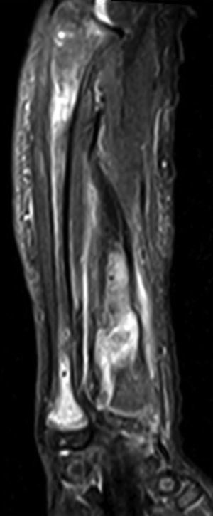 Imagen RM sagital en T2 y STIR del antebrazo, donde se observa hiperintensidad de los infiltrados condrales en la medular ósea del cubito y radio.