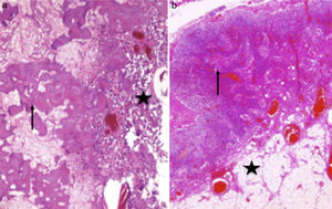 a) La pieza de resección del tumor primario está constituida en un 60% por necrosis tumoral, en su mayoría en forma de osteoide mineralizado y necrosado (flecha), y un 40% por células neoplásicas con producción de matriz osteoide (estrella) (H&E ×100); b) Ganglio linfático con arquitectura conservada. Los senos medulares se encuentran ocupados por histiocitos (flecha), y se aprecia involución de grasa parcial (estrella). No se observa infiltración neoplásica (H&E ×40).